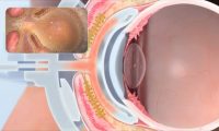 眼睛机理动画：医学三维动画制作、医学演示动画制作